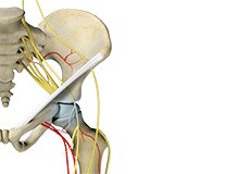 Avascular Necrosis (Osteonecrosis of the Hip)