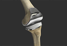 Correction of Loose Knee Replacement