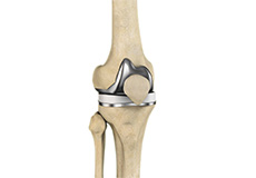 Correction of Painful Knee Replacement