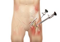 Hip Arthroscopy