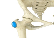 Hip Bursitis