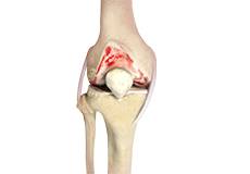 Knee Arthritis