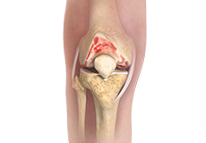 Surgical Treatment of Osteoarthritis of the Knee