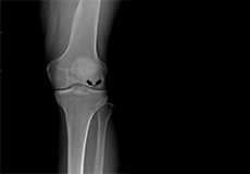 Osteonecrosis of the Knee