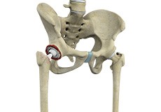 Revision Hip Replacement