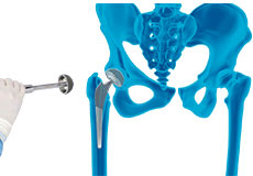 Robotic Total Hip Replacement