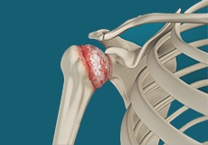 Arthritis of the Shoulder