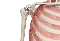 Shoulder Joint Replacement