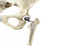 Total Hip Replacement