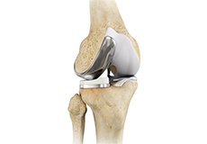 Unicompartmental Knee Replacement